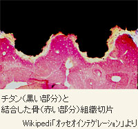 チタン（黒い部分）と結合した骨（赤い部分）組織切片